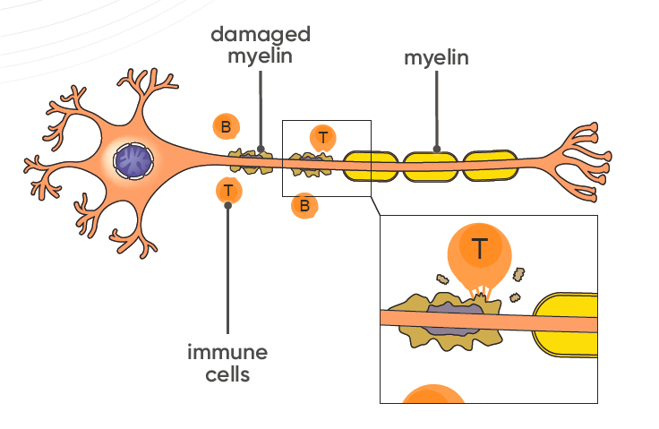 Affected nerve cell