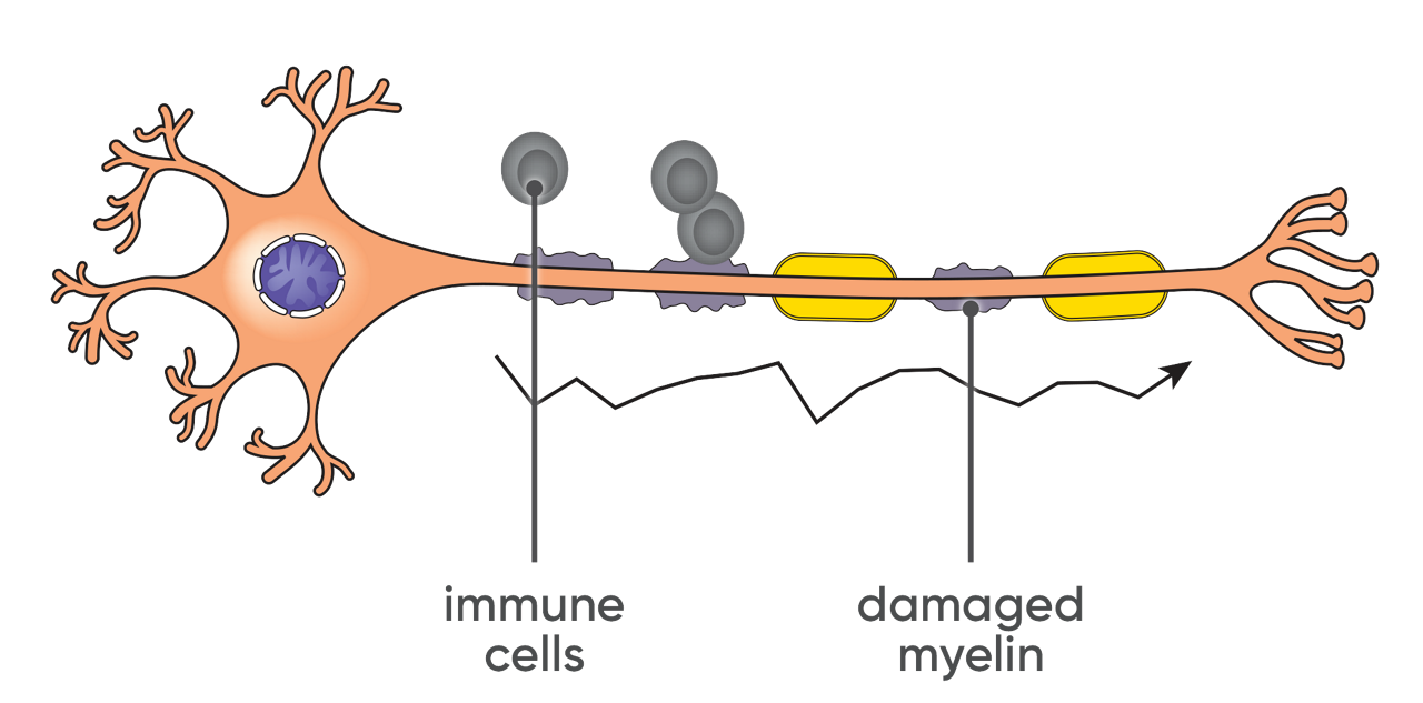 Affected nerve cell