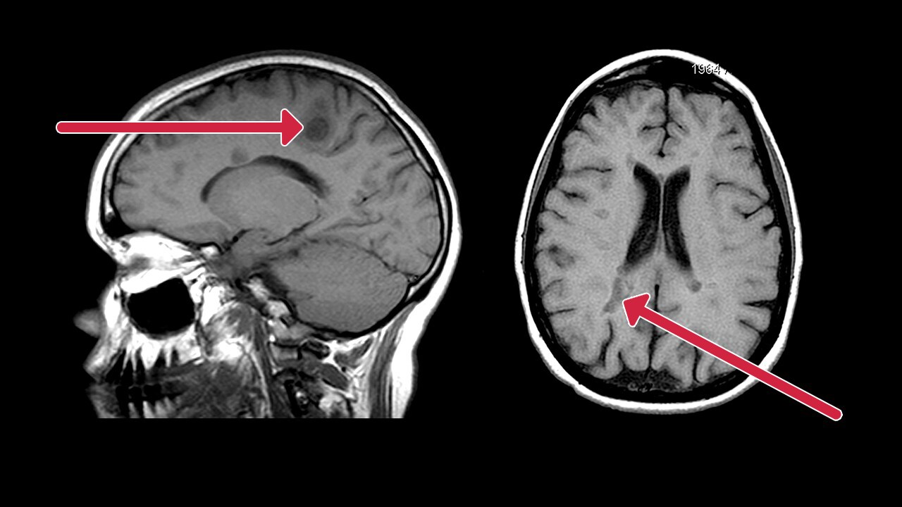 T1-weighted MRI 
