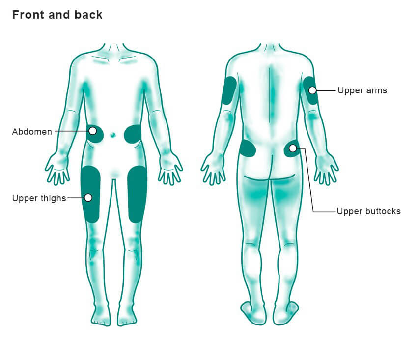 Injection Sites