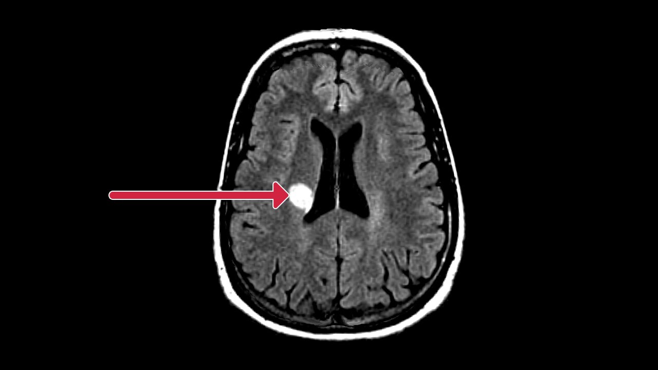 Gadolinium-enhanced MRI