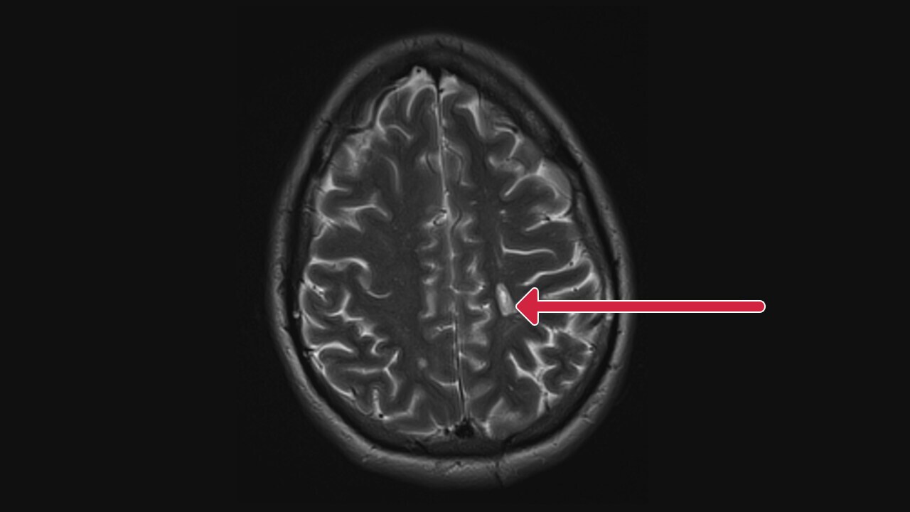 T2-weighted MRI